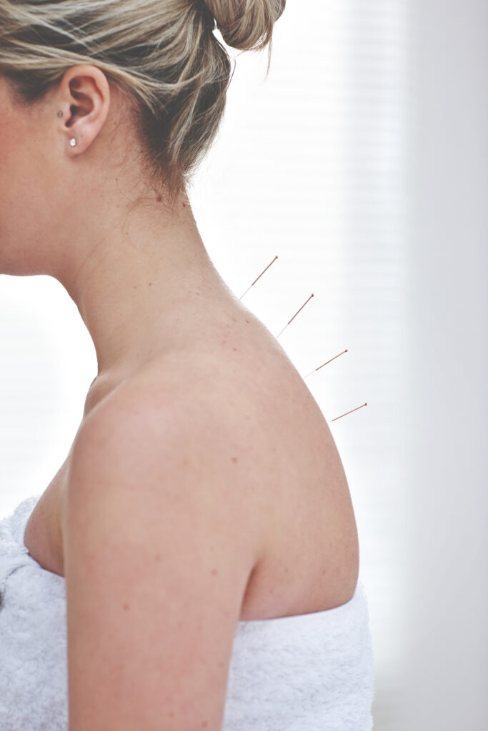 acupuntura em ipatinga